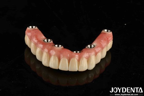Đường cấy ghép răng Titanium Malo kết hợp các kỹ thuật truyền thống và hiện đại