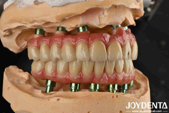 Công nghệ lai Titanium Malong Dental Bridge điều chỉnh cho kết quả thẩm mỹ