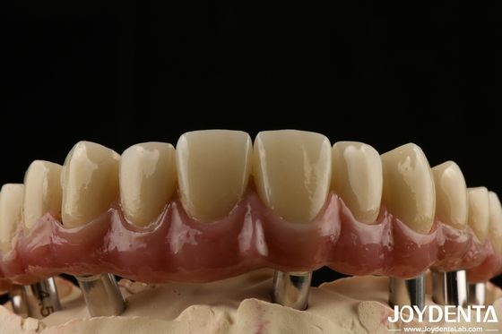 Titanium Malong Dental Hybrid Bridge lâu dài điều chỉnh phù hợp mật độ thấp