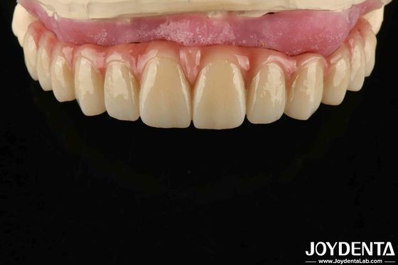Thư giãn thoải mái Titanium Malong Hybrid Bridge Thiết kế điều chỉnh răng nhẹ