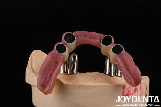 Các thiết bị răng chính xác hỗ trợ răng giả một phần Khôi phục chính xác
