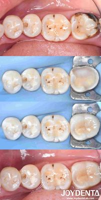 Tái thiết lập nhựa sứ nha khoa tùy chỉnh để sửa chữa răng hoàn hảo