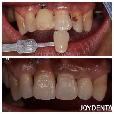 Tùy chỉnh nha khoa Zirconia veneers màu tự nhiên phục hồi giống như cuộc sống