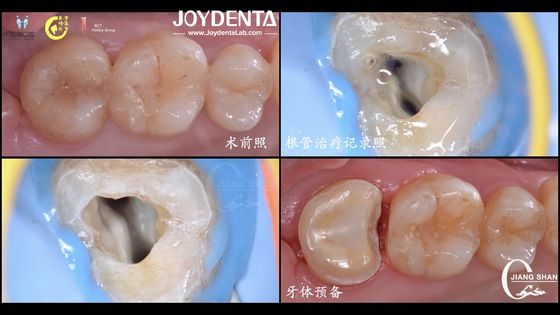 Long Lasting Natural Looking Dental Ceramic Inlay Chi tiết phù hợp Hoàn độ tương thích
