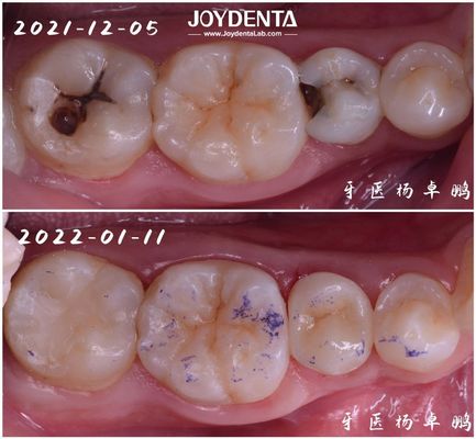 Độ bền cao Inlay phục hồi răng cho răng hư hỏng Có nhiều kích cỡ khác nhau