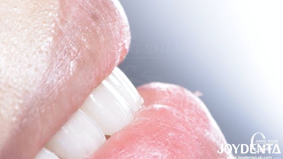 Long Lasting Dental Composite Veneer Tốt Biocompatibility Không Giả Giảm veneers sứ