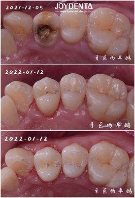 Đúng phù hợp răng sứ đính kèm răng hư hỏng phục hồi cho người lớn và trẻ em