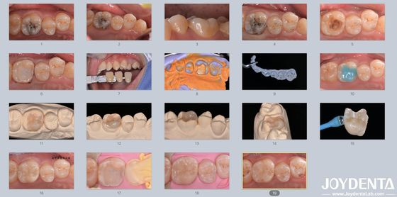 Người lớn Trẻ em Đồ xốp gốm mộc răng tái tạo cho răng bị hư hại