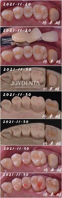 Phương pháp nha khoa bằng vải sứ không mỏng hình dạng tùy biến để sửa chữa răng