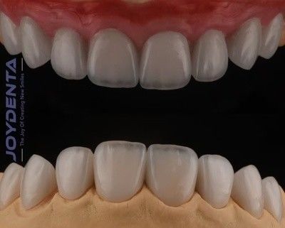 Phân cảnh Feldspathic xuyên suốt cao, Phân cảnh sứ mỹ phẩm có độ bám chặt