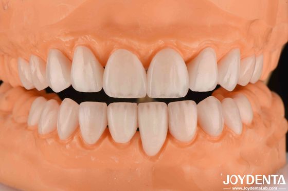 Phụ lục gốm Emax 0.3-0.5mm Độ dày Long Lasting Cosmetic Porcelain Veneers