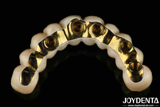 Tự chế Ti-Bar Zirconia Hybrid Bridge Precision Fit Dental Prothesis