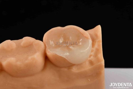 Polymerized porcelain Composite Inlay And Onlay Phục hồi thẩm mỹ và bền