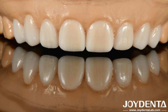 Chất liệu đa dạng kim loại và nhựa kết thúc răng giả linh hoạt cho công nghệ tàng hình tiên tiến