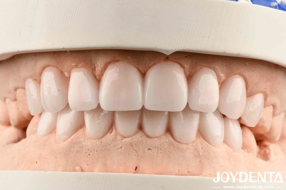 Các vật liệu đa dạng và độ đàn hồi tốt trong kết thúc răng giả linh hoạt cho kim loại và nhựa