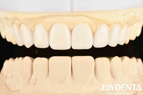 Năng lượng tốt của nha khoa và công nghệ sắp xếp răng Denture linh hoạt hoàn thành trong chăm sóc răng