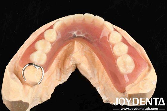 Kim loại và nhựa khung thiết lập răng kết thúc cho cấu trúc miệng ổn định trong cấu hình răng