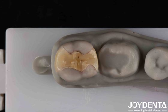Cementation an toàn Onlay an toàn cho khôi phục lâu dài và thẩm mỹ