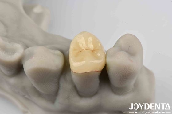 Cementation an toàn Emax Inlay Onlay dễ làm sạch và chống mờ