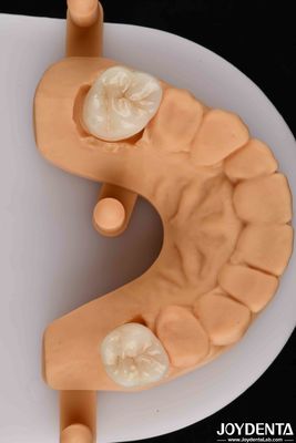 Vẻ đẹp tự nhiên với sự kết hợp thắng lợi của Zirconia nha khoa tương thích sinh học