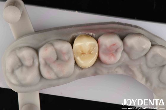 Độ cứng gãy 9 MPa·m1/2 Tính thẩm mỹ cao Kháng mòn cao