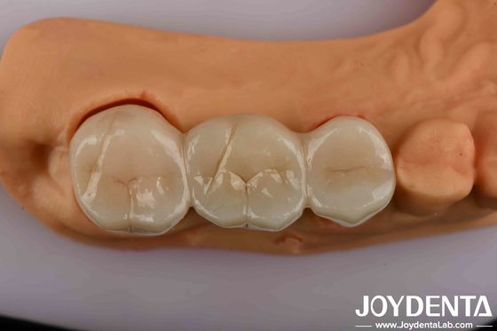 Dental Zirconia cao sức mạnh giải pháp cuối cùng của bạn cho vẻ ngoài thẩm mỹ tự nhiên