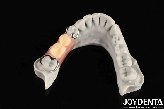 Cấu trúc miệng ổn định cho các chuyên gia nha khoa để kết nối chặt chẽ các răng hàng