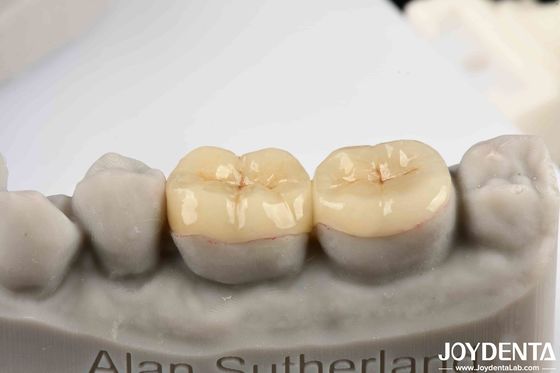 Emax Inlay Onlay Phù hợp chính xác Và Hypoallergenic Biocompatibility Dễ lau