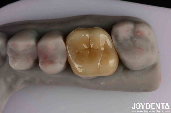 Độ mờ trung bình Emax Inlay Onlay Dễ lau và không độc hại Biocompatibility trong vật liệu
