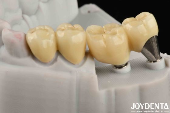 Cây cấy ghép Crown And Bridge trông tự nhiên an toàn cho hiệu suất uống lâu dài