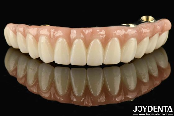 Ti-Bar Zirconia Hybrid Bridge tương thích với răng và nướu tự nhiên Tự truyện phục hồi chức năng nhai