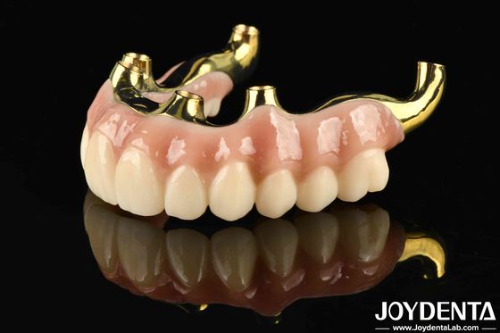 Khôi phục chức năng nhai Ti-Bar Zirconia Hybrid Bridge với khả năng tương thích sinh học cao và phù hợp chính xác