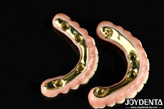 Phong cách thẩm mỹ tự nhiên Cây cầu lai Zirconia với độ bền cao và tương thích sinh học Ti-Bar Zirconia Hybrid Bridge