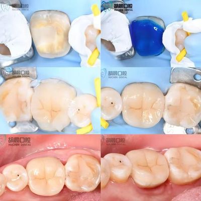 Trải nghiệm độ chính xác của lớp phủ răng giá cả phải chăng và màu trắng cho phù hợp hoàn hảo