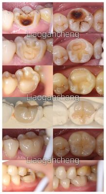 Đồ xốp răng để phục hồi cho người lớn và trẻ em Hiệu suất đặc biệt
