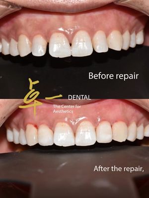Hãy chào một nụ cười hoàn hảo với veneers mỹ phẩm răng không đổi màu không chuẩn bị