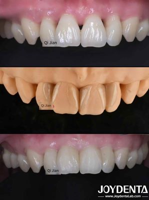 Ghi đốm là giải pháp hoàn hảo cho các loại ghi đốm răng xuyên suốt tự nhiên
