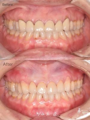 Tăng khả năng chống gãy cao Zirconia nha khoa cho mô răng miệng an toàn và tương thích CAD / CAM