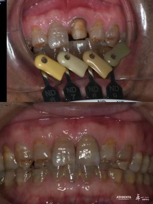 Translucency Zirconia Crown Công nghệ gradient đa lớp cho độ mờ tối ưu và khả năng tương thích sinh học lâu dài