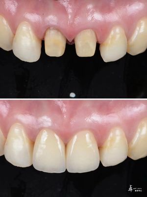Veneers được làm bằng Zirconia nha khoa chống gãy cao và công nghệ gradient đa lớp