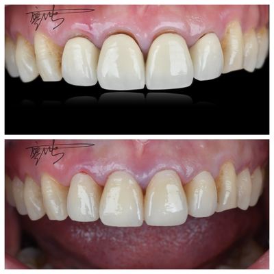 Cây cầu nha khoa Zirconia thoải mái Đường cầu nha khoa có trọng lượng nhẹ Chuyển đổi màu tự nhiên cho trải nghiệm bệnh nhân tối ưu