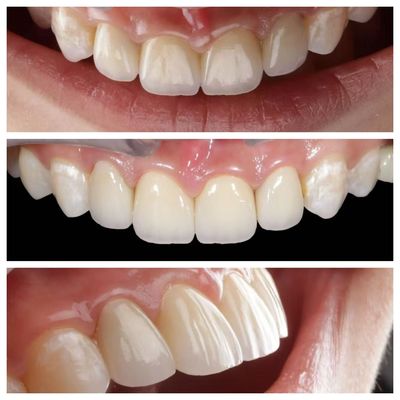 Nhãn phía trước chỉ thị veneers răng với độ dày 0,5mm và độ thấm hoàn hảo