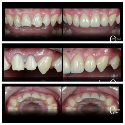 Vỏ răng tự nhiên cho nụ cười tự nhiên và đẹp