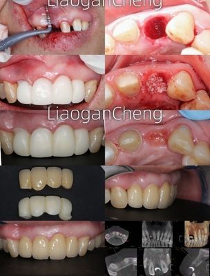 Công nghệ sườn đa lớp Zirconia răng an toàn và thẩm mỹ lâu dài