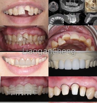 Tương thích sinh học Vương miện răng Zirconia an toàn cho phục hồi lâu dài và cấy ghép hỗ trợ