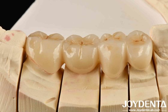 Giải phóng thẩm mỹ của thẩm mỹ cao đầy đủ Zirconia với màu trắng và chống sốc nhiệt cao