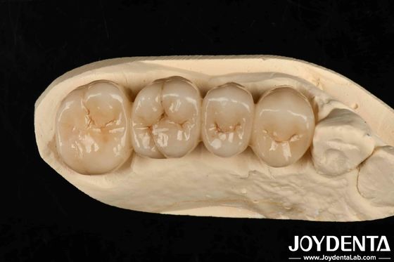 Nhiều lớp Full Zirconia Phong cách trắng với các lớp Trò xuyên suốt cao Kháng nứt cao