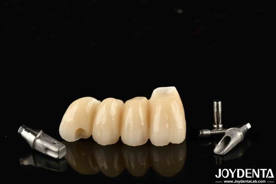 Địa vị và cây cầu cấy ghép được tùy chỉnh trong sứ chính xác cho chức năng hoàn hảo