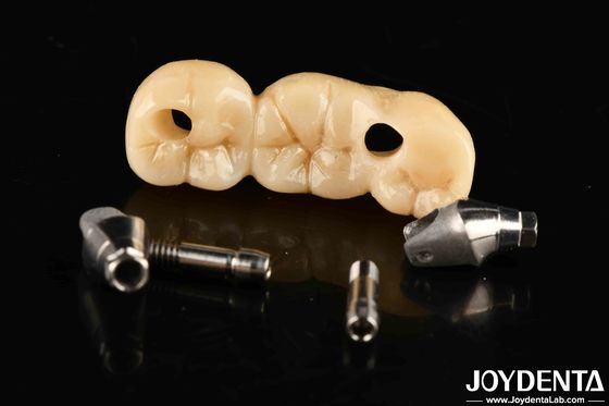 Strong Implant Crown And Bridge Giải pháp hoàn hảo cho vẻ đẹp đẹp