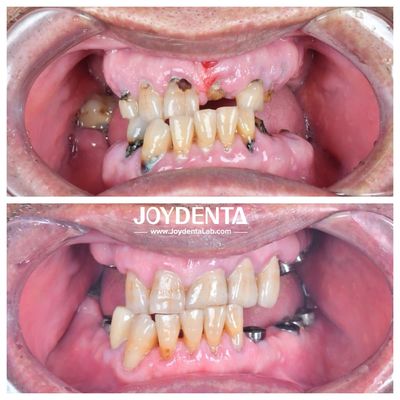 Chống mòn và biến dạng Circonia vương miện răng bền và phù hợp cho phục hồi phía sau và phía trước